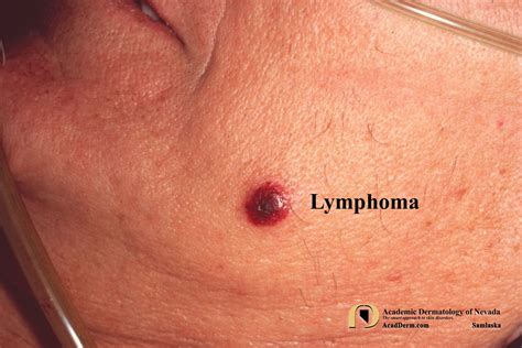 cutaneous lymphoma  contribute   leukemia lymphoma