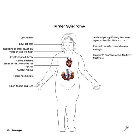 Turner Syndrome Usmle Strike