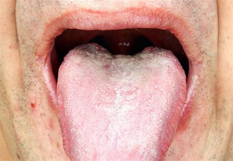 Yeast Infection On Tongue Treatment Porno Picture