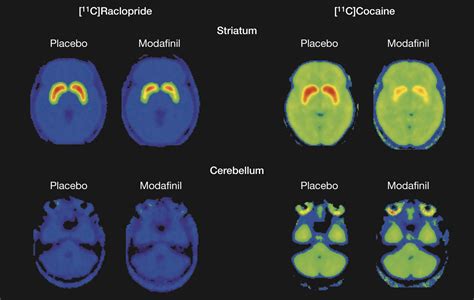 effects of modafinil on dopamine and dopamine transporters