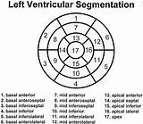 Segmentation Heart Cardiac Myocardial Imaging Segments 17 Aha Left Ase Ventricle Polar Tomographic Nomenclature Ahajournals Mid Display Standardized Figure Inferolateral sketch template