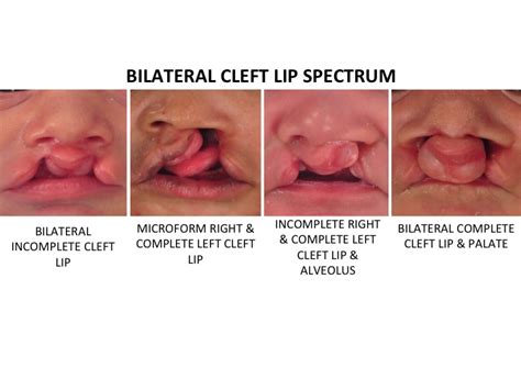 bilateral cleft lip  palate dallas pediatric plastic surgeon
