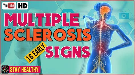 16 Multiple Sclerosis Symptoms Early Warning Signs