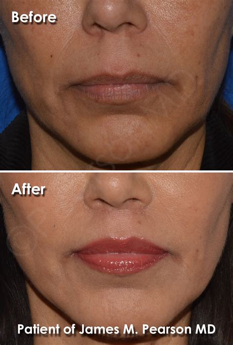 cost of surgical lip lift lips makeupview