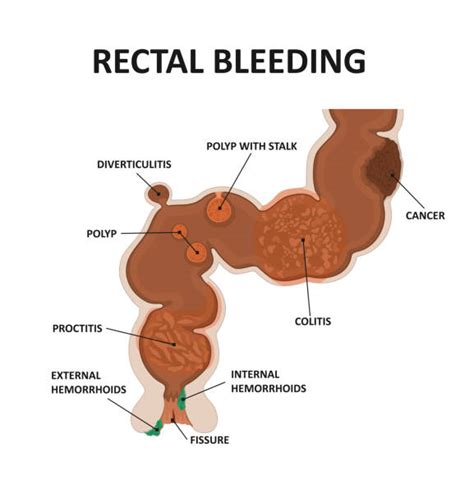 30 Rectal Diagram Pics Stock Illustrations Royalty Free Vector