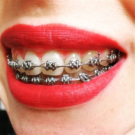 pin on beautiful braces
