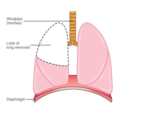stage   lung cancer