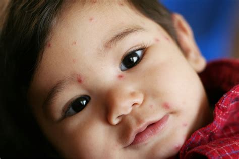 Chicken Pox Symptoms And Key Facts Qoctor Your Online Doctor