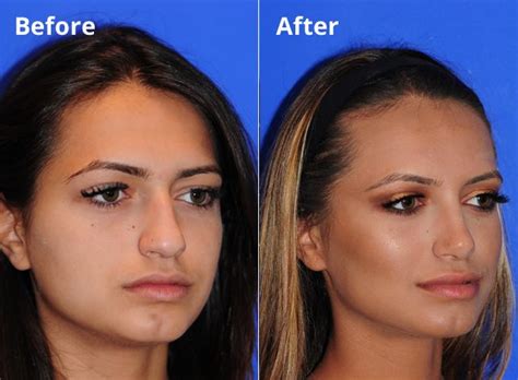 combining your rhinoplasty nose job with a chinimplant