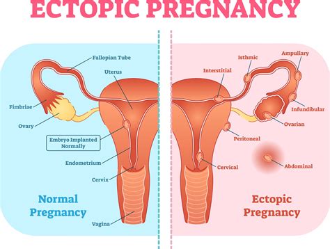 ruptured ectopic pregnancy symptoms signs  ruptured ectopic