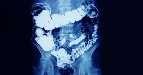 Whats Gone Wrong With Managing Bowel Cancer In Australia Pursuit By