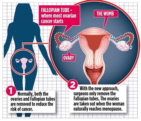 New Operation Cuts The Risk Of Ovarian Cancer And An Early Menopause