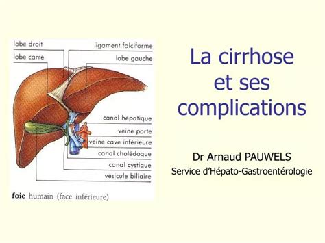 Ppt La Cirrhose Et Ses Complications Powerpoint Presentation Free