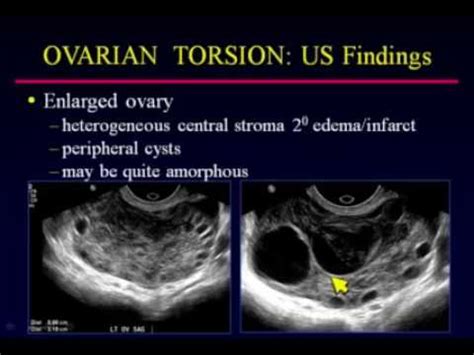 sonographic evaluation  ovarian torsion youtube