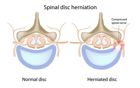 common symptoms  lumbar disc herniations elite sports  spine