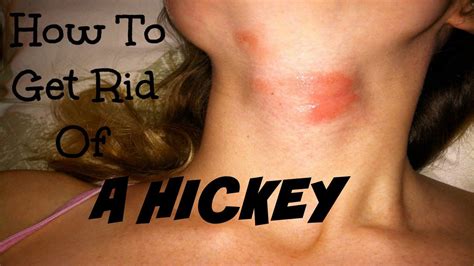 a hickey also known as a kiss mark or love bite is