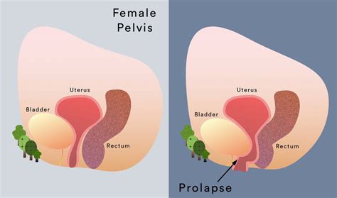 Pelvic Organ Prolapse Symptoms And Treatment My Gynae