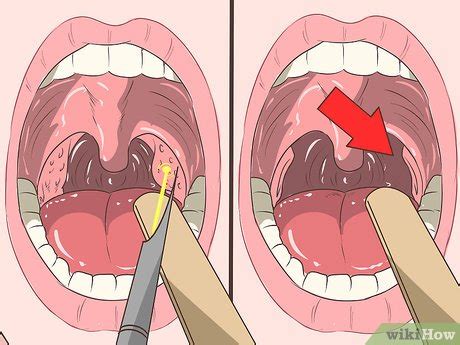 ways  remove tonsil stones tonsilloliths wikihow
