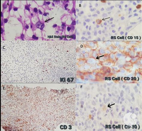 A Case Of Classical Hodgkin Lymphoma With Pancytopenia