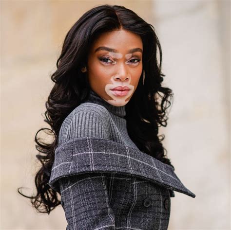 Model Winnie Harlow Isnt A ‘vitiligo Sufferer