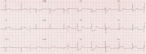 difference  reading  interpreting   lead ecg advanced ecg courses