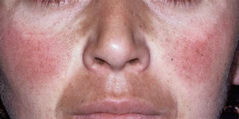 7 Melasma Treatments How To Treat Brown Spots On Skin