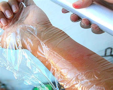 breakthrough cling wrap biomaterial protects burn victims