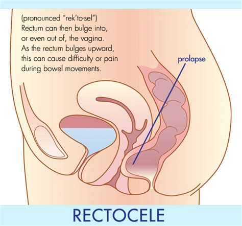 Pelvic Prolapse Bayside Gynecology Gynecologist Venice