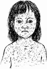 Health Children Measles Rubeola Problems Hesperian Rash sketch template