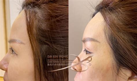 forehead filler radiesse advanced dermal filler dr sin yong