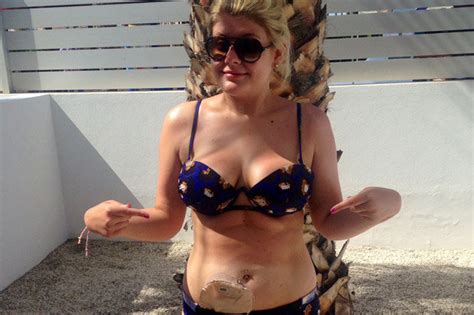 beach body ready woman with colostomy bag hits back at