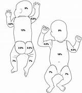 Rule Nines Burns Lund Burn Infant Browder Chart Infants Pediatrics Classification Children Toddler Wound Drawing Illustration Rn Nclex Visit Management sketch template