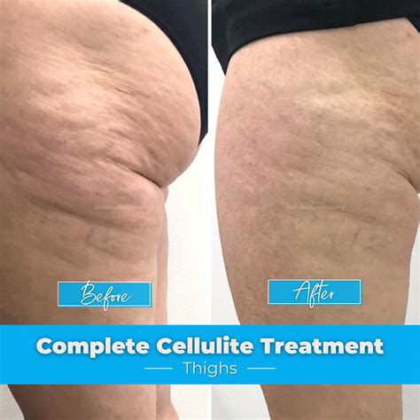 cellulite results before and after elite body contouring