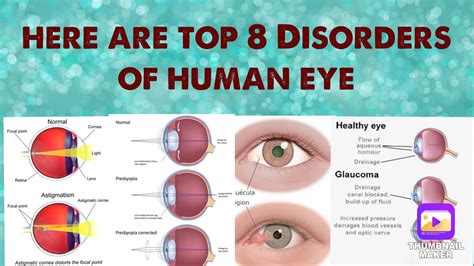 Disorders Of Human Eye Youtube