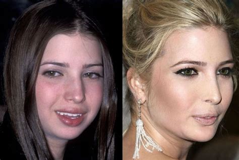 plastic surgery disasters    page  funtalitycom   celebrity
