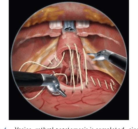 Figure 2 From [bidirectional Barbed Suture For Bladder Neck