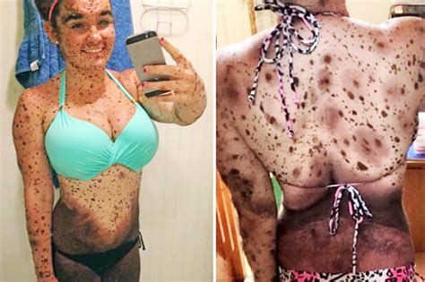 girl with hundreds of birthmarks on face and body flaunts