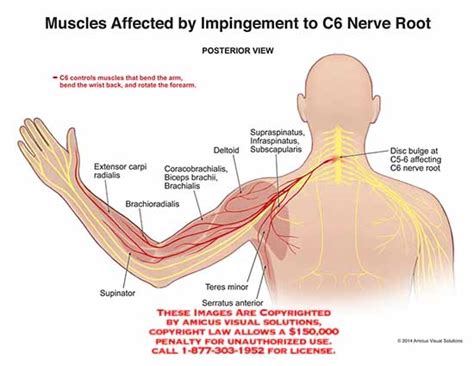 muscles affected  impingement   nerve root