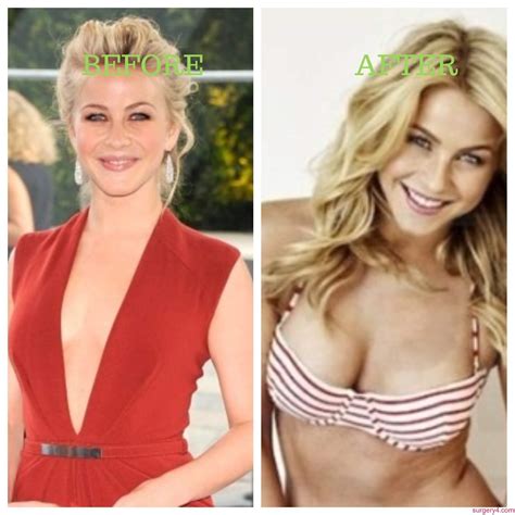 julianne hough plastic surgery photos [before and after] surgery4