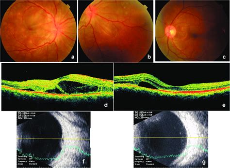 multiple yellowish roundoval lesions   level