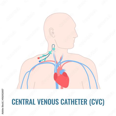 Central Venous Catheter Placed In The Jugular Vein Man With Cvc Access