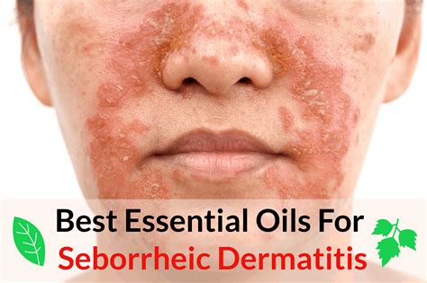 essential oils  seborrheic dermatitis essential oil benefits