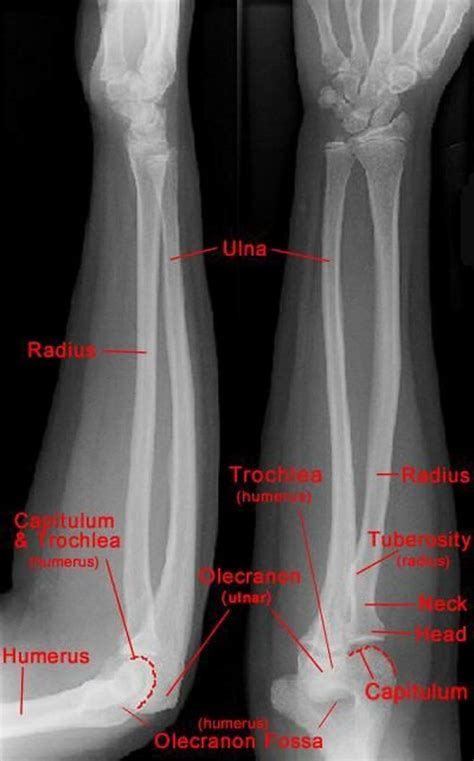 forearm radiograph medical radiography radiology student medical anatomy