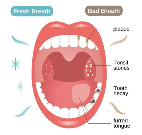 cure bad breath permanently  holistic approach