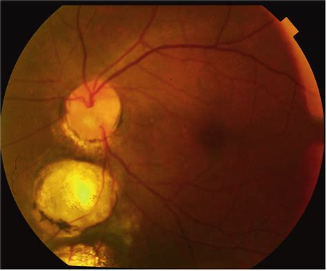 fundus photograph  choroidal coloboma   patches  coloboma