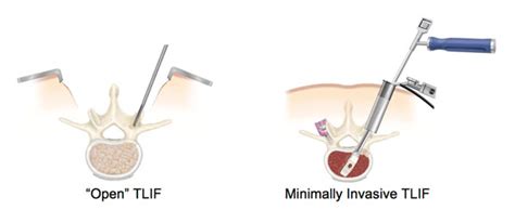 Transforaminal Lumbar Interbody Fusion Tlif Spine Surgery