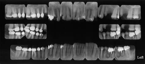 Full Mouth X Rays Ddi Imaging Centers