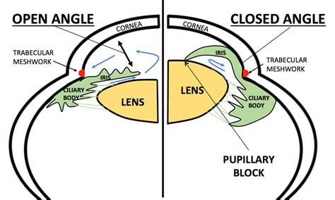 moran core acute angle closure glaucoma