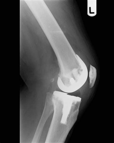 total knee replacement surgery information and advice guido geutjens