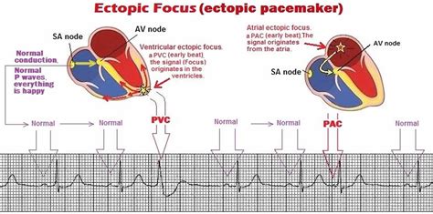 ectopic pacemaker beats  symptoms diagnosis treatment